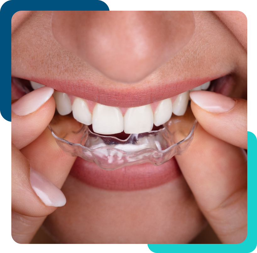 women putting in clear aligners