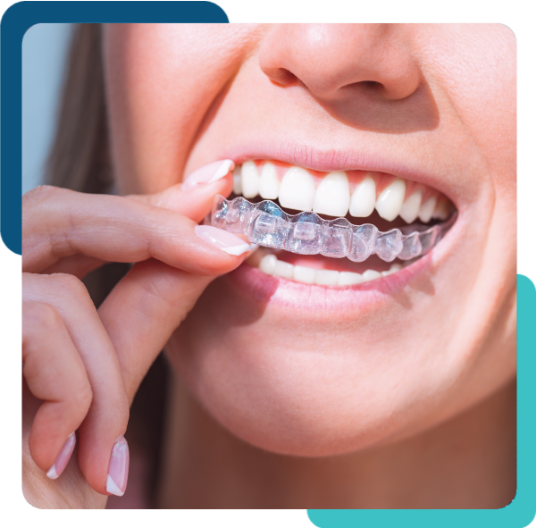 women using smile clear aligners