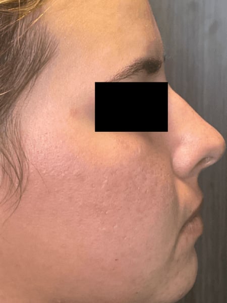 microneedling after 1
